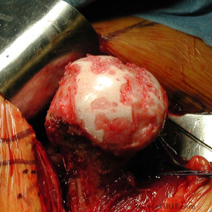 Typische Abnutzung mit Knorpelschäden am Oberarmknochenkopf bei der Operation